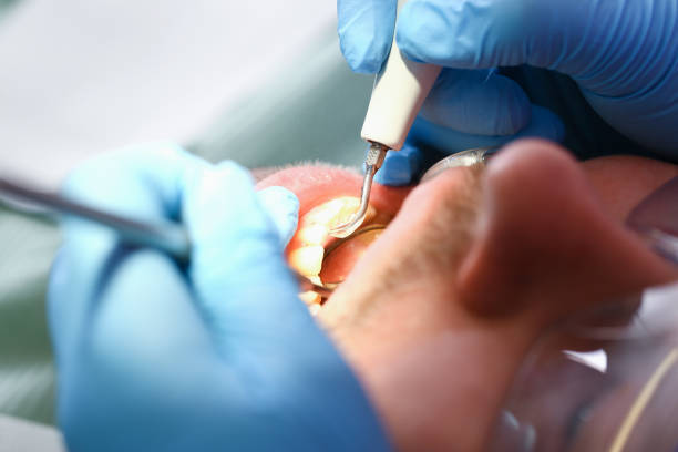 Best Chipped Tooth Repair Near Me  in Catawba, SC